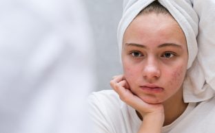 بهترین پماد برای جای جوش صورت